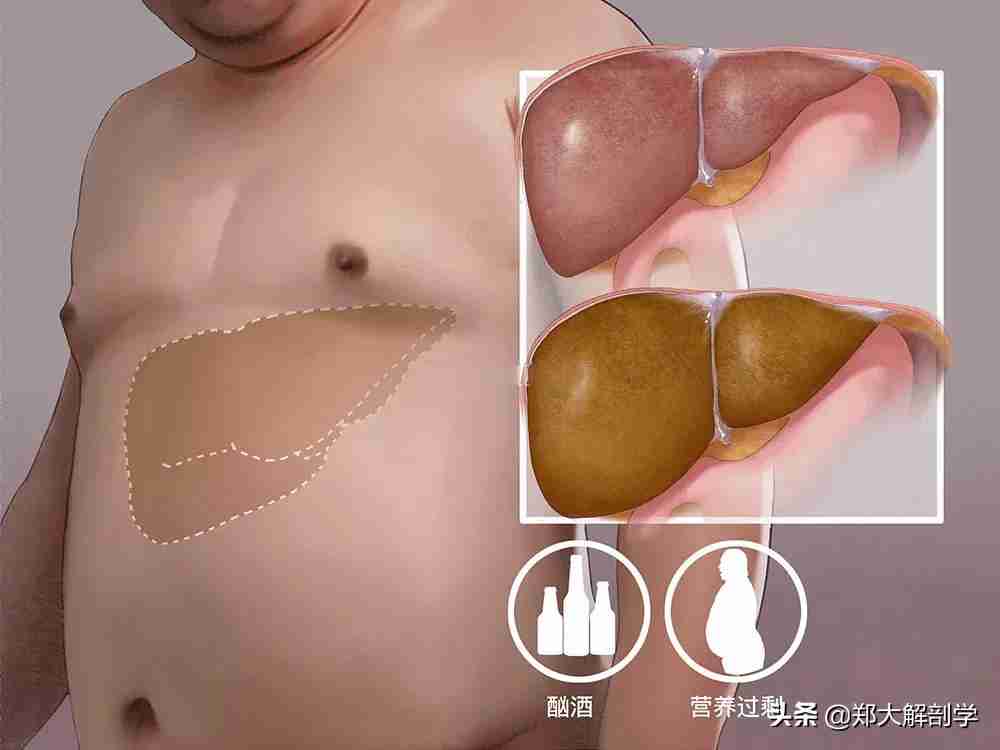 脂肪肝的症状（脂肪肝可能会出现这些症状） 第1张