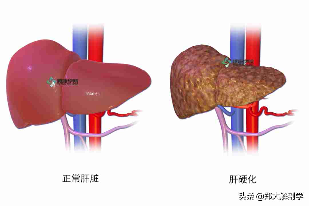 脂肪肝的症状（脂肪肝可能会出现这些症状） 第5张