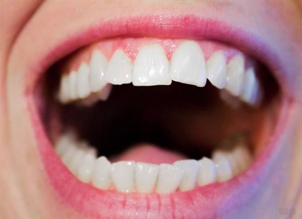 缓解牙疼的8个简单方法（快速缓解牙齿痛的小妙招和牙痛的注意事项） 第1张