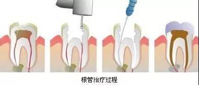 补的牙齿能用多久(补牙需要多少天全部完成) 第5张